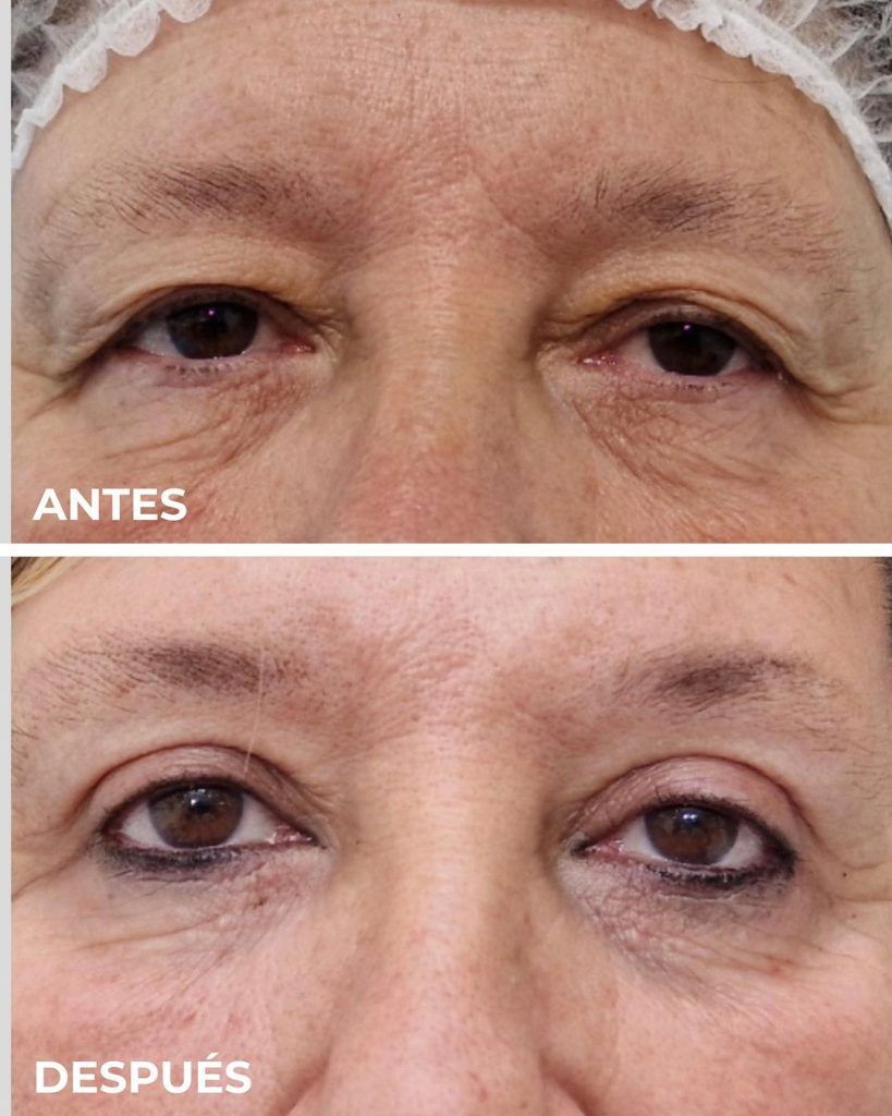 Blefaroplastia Láser Madrid