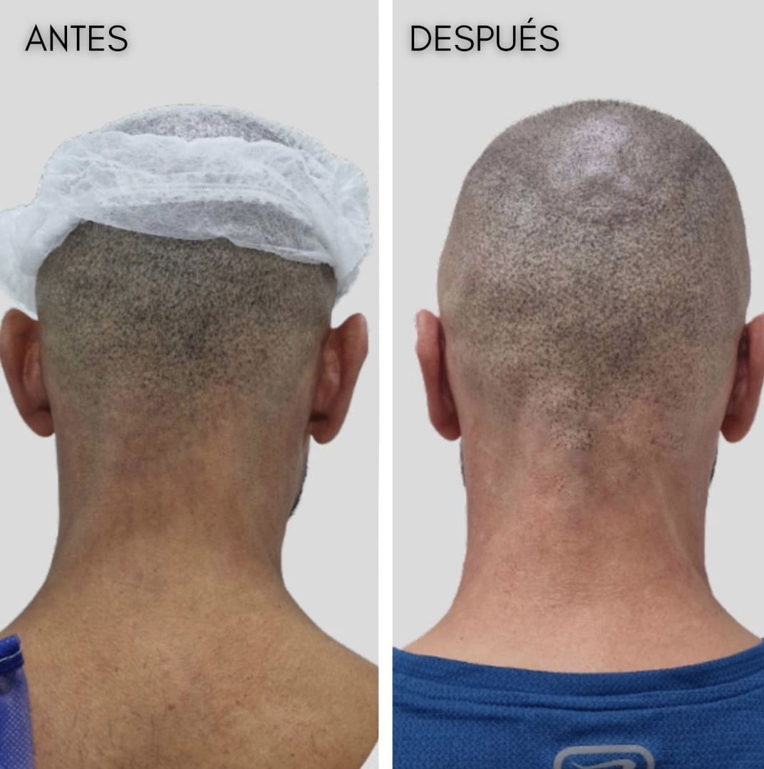 Otoplastia Otoplastia Madrid