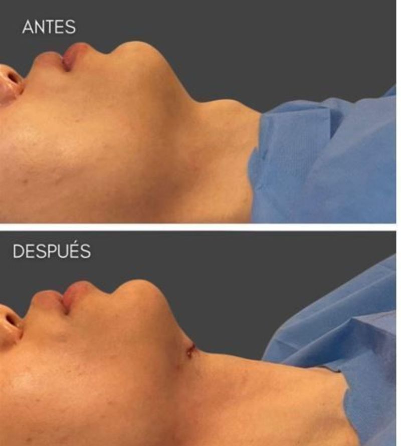 Condrolaringoplastia