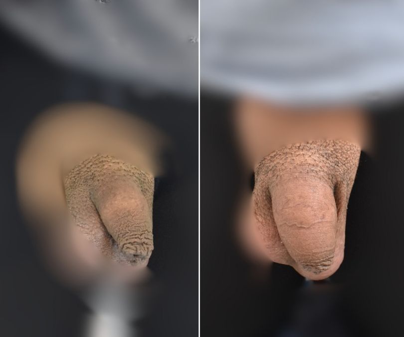 engrosamiento de pene antes y despues 2 engrosamiento de pene antes y despues 2