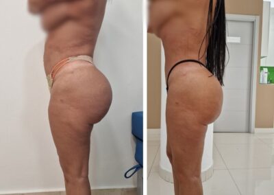 extracción de biopolímeros gluteos (2)