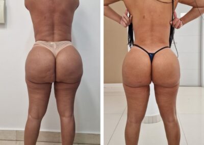 extracción de biopolímeros gluteos
