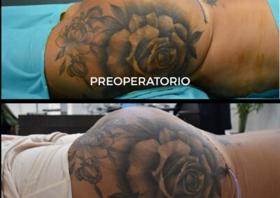 retirada de biopolímeros glúteos