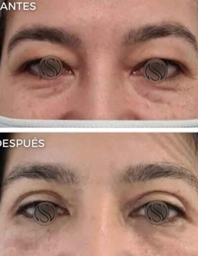 Blefaroplastia Dr Sturletti Madrid (2)