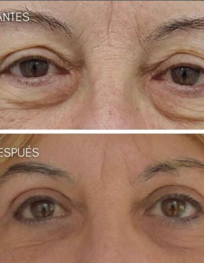 Blefaroplastia Dr Sturletti Madrid (3)