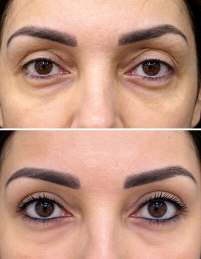 Blefaroplastia Dr Sturletti Madrid