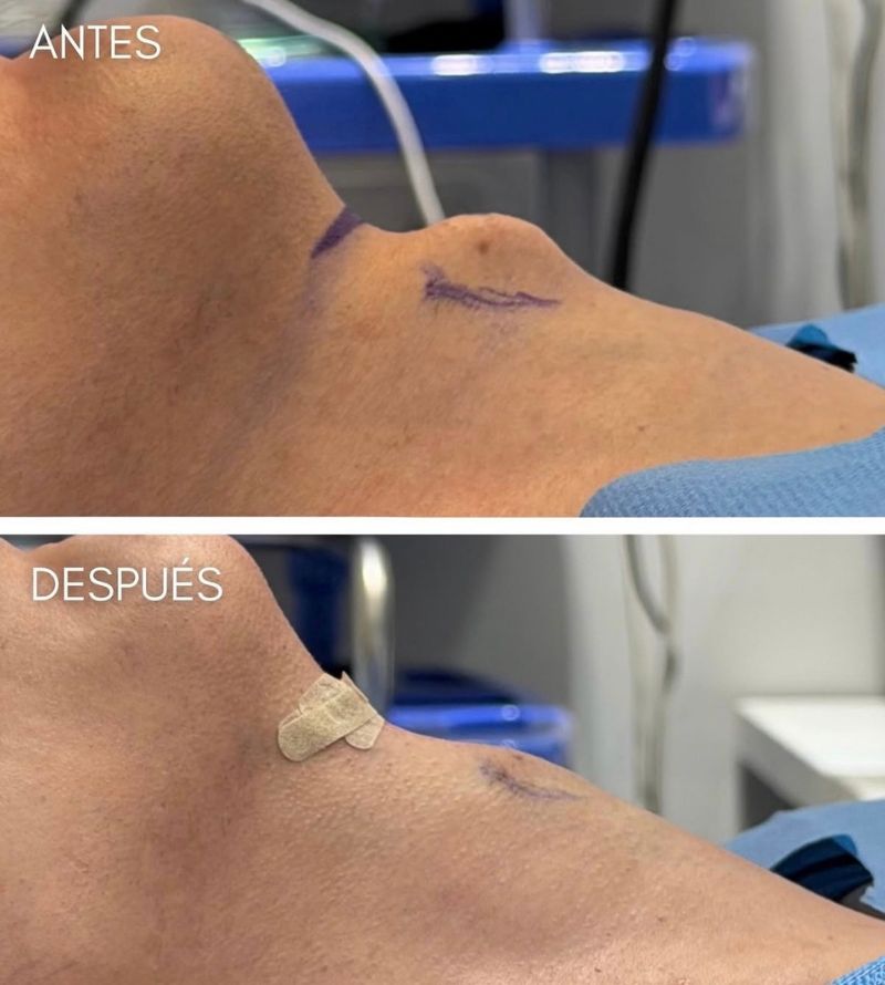 antes y despues Condrolaringoplastia nuez de adán (1) antes y despues Condrolaringoplastia nuez de adán